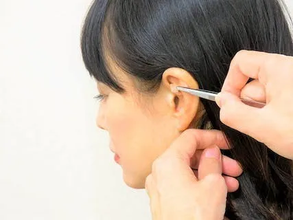 耳ツボダイエット施術の様子
