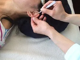 耳ツボダイエット施術の様子