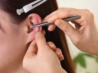 耳ツボダイエット施術の様子