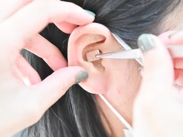 耳ツボダイエット施術の様子